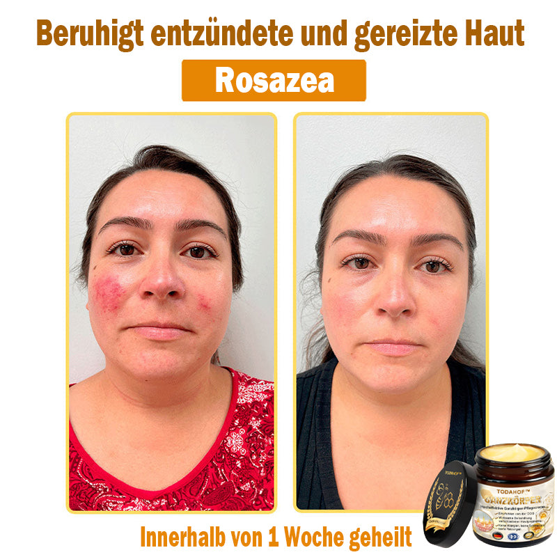 Steroidfrei🥑 TODAHOF® Hocheffektive Ganzkörper Pflegecreme 👩⚕️ (für mehrere Bereiche und Hautprobleme)