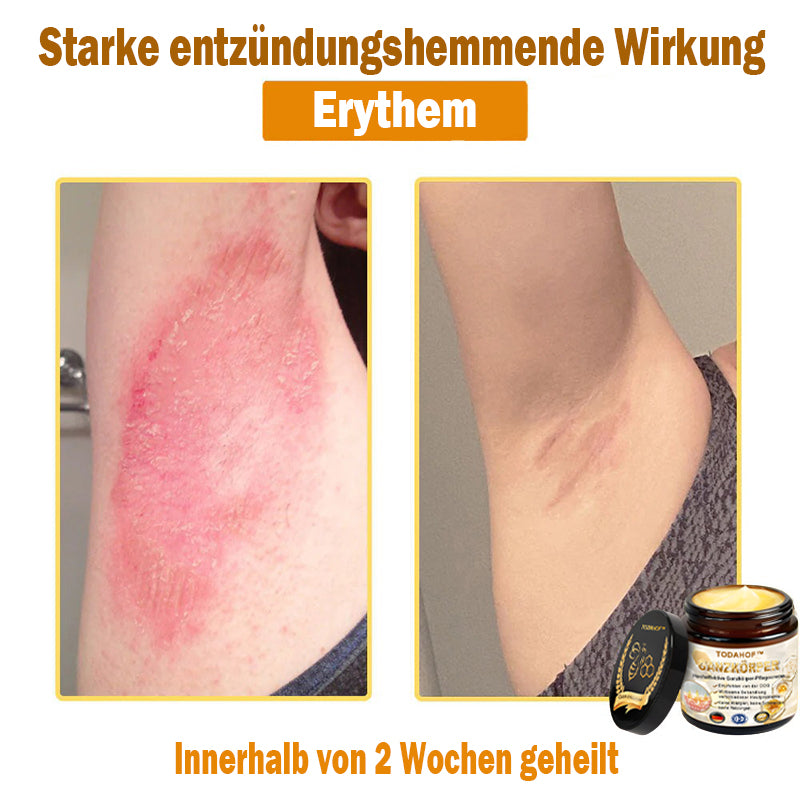 Steroidfrei🥑 TODAHOF® Hocheffektive Ganzkörper Pflegecreme 👩⚕️ (für mehrere Bereiche und Hautprobleme)