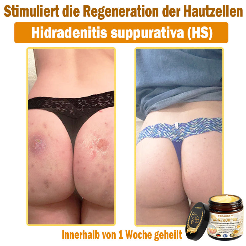 Steroidfrei🥑 TODAHOF® Hocheffektive Ganzkörper Pflegecreme 👩⚕️ (für mehrere Bereiche und Hautprobleme)